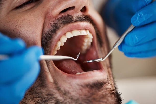 Best Emergency Wisdom Teeth Removal in East Williston, NY